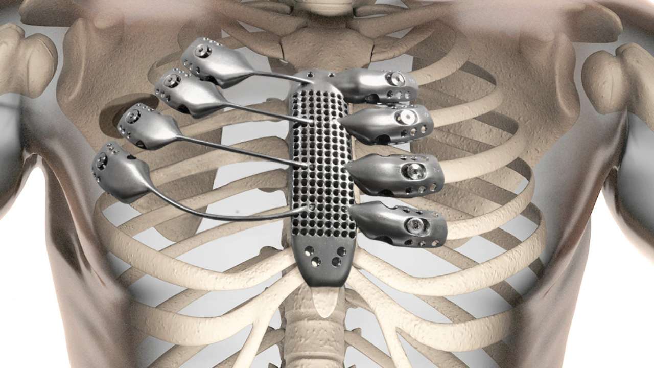 Ученые из СГТУ разработали покрытие, повышающее прочность титановых имплантов для сращивания костей при переломах